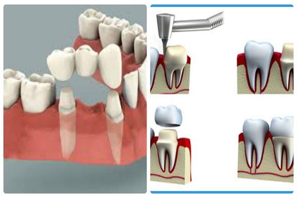 bọc răng sứ, ham bọc răng sứ, kỹ thuật bọc răng sứ, hệ lụy của việc bọc răng sứ