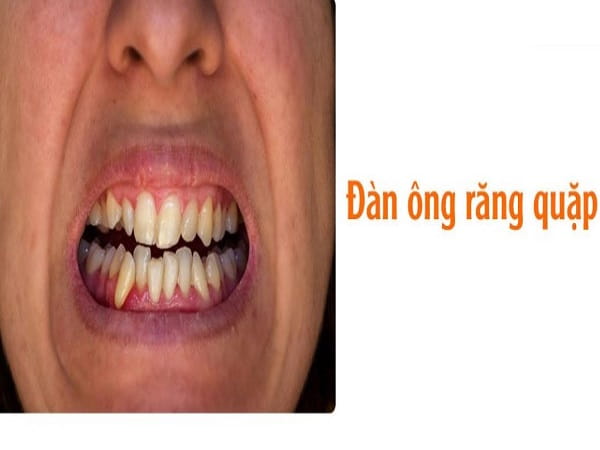 Tướng đàn ông răng quặp vào trong nói lên điều gì?