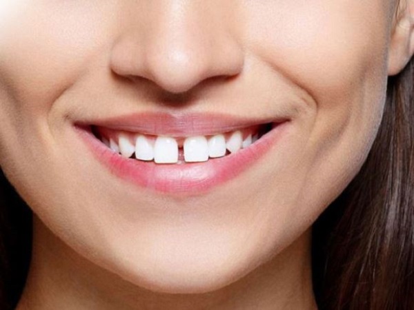 Răng cửa thưa sướng hay khổ?